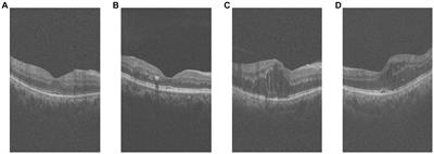 Lesion-aware attention network for diabetic nephropathy diagnosis with optical coherence tomography images
